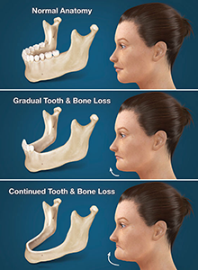 Full Arch Dental Implants Goshen