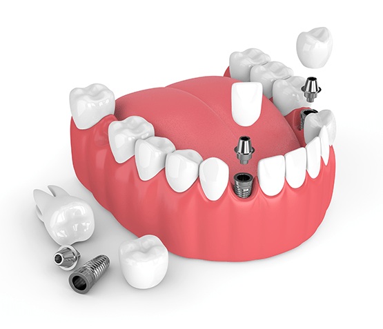 Dental Implants Goshen