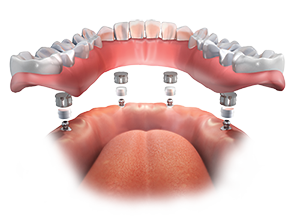 Upper Denture